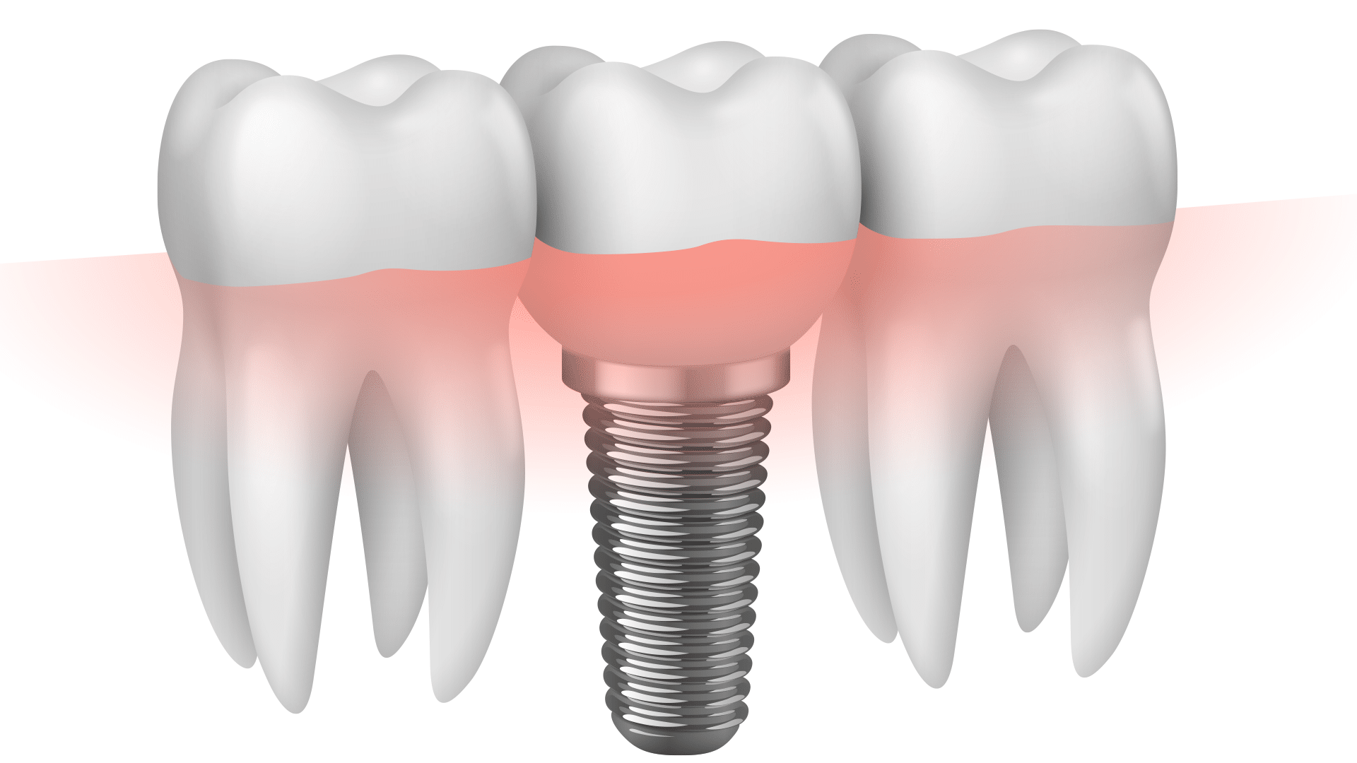 dental-implant-2