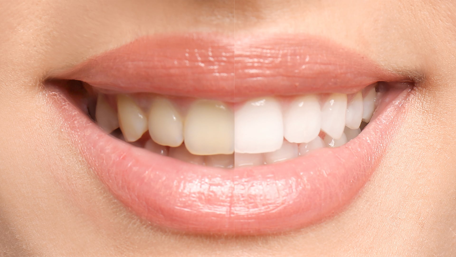 teeth-whitening