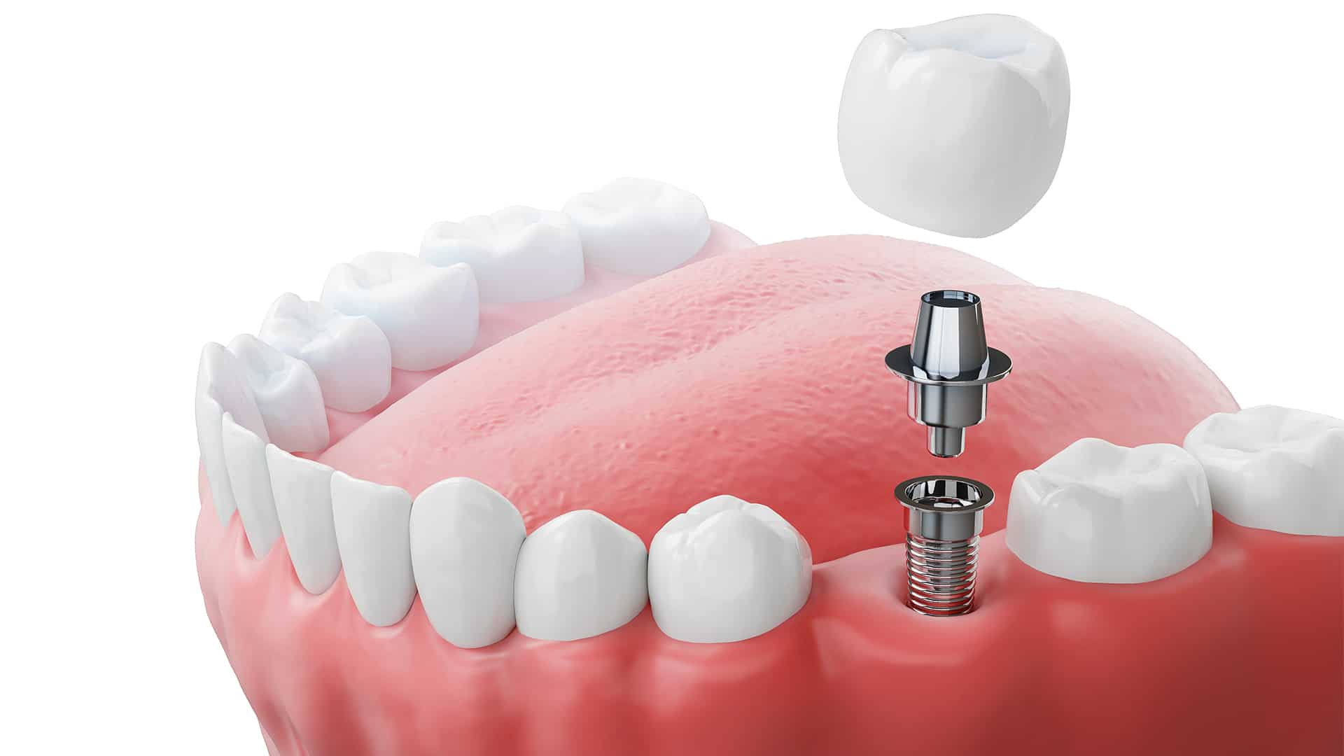 tooth-implant